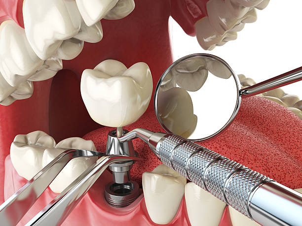 Best Emergency Root Canal Treatment in West Samoset, FL